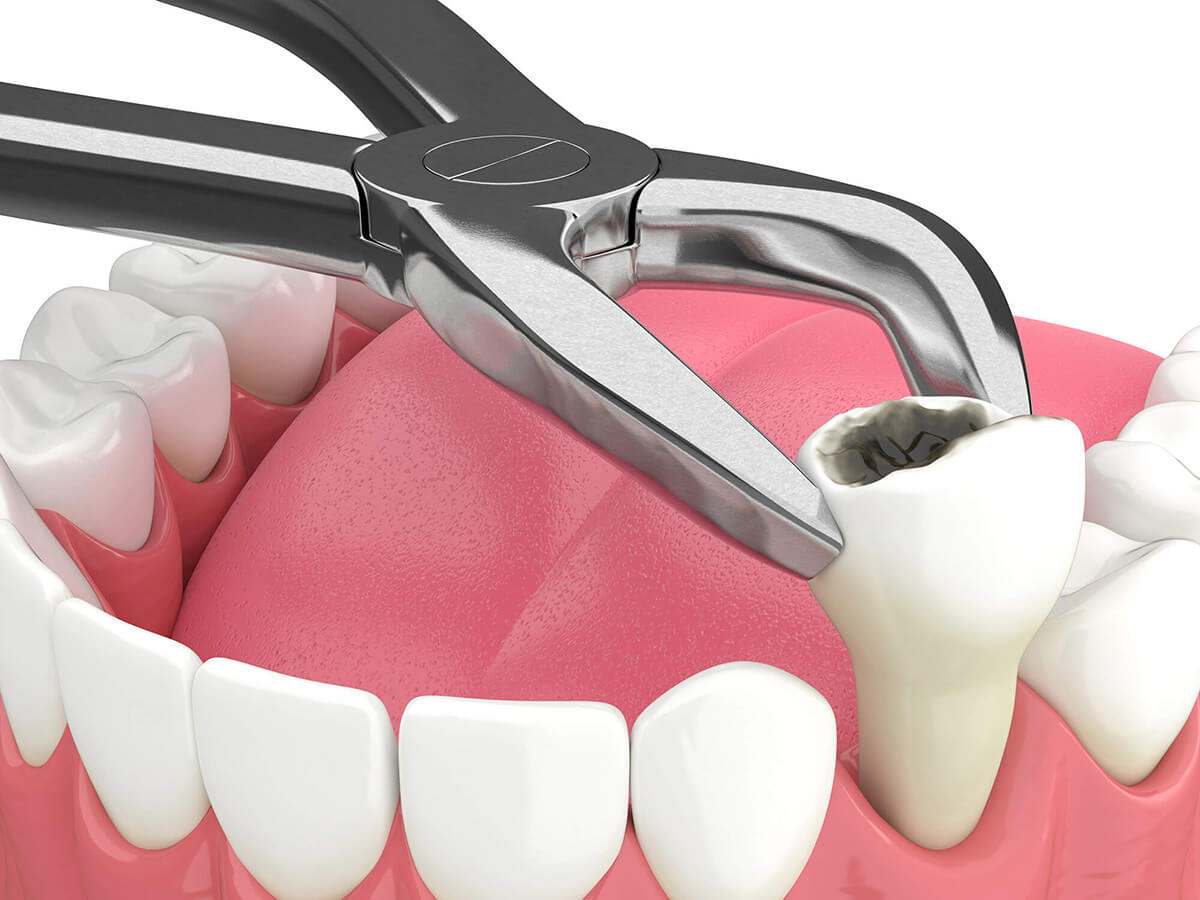 Tooth Removal