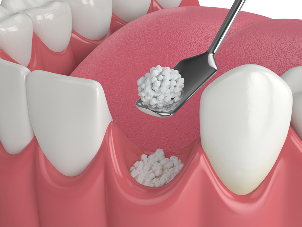 Dental Bone Graft